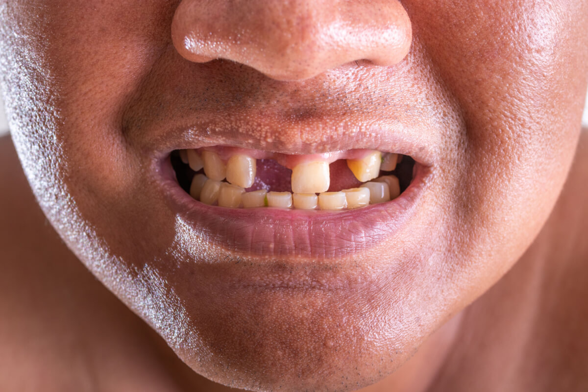 close up young man broken teeth