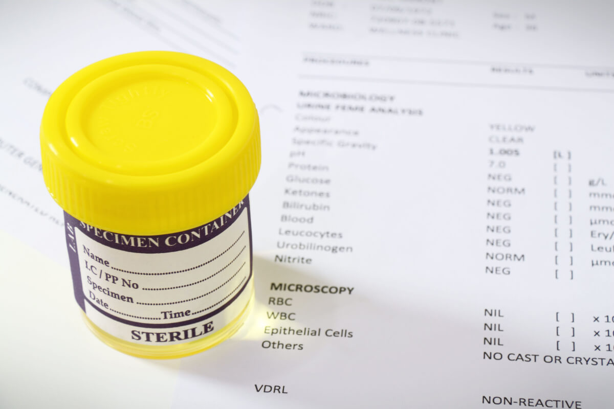 urine sample container over medical report